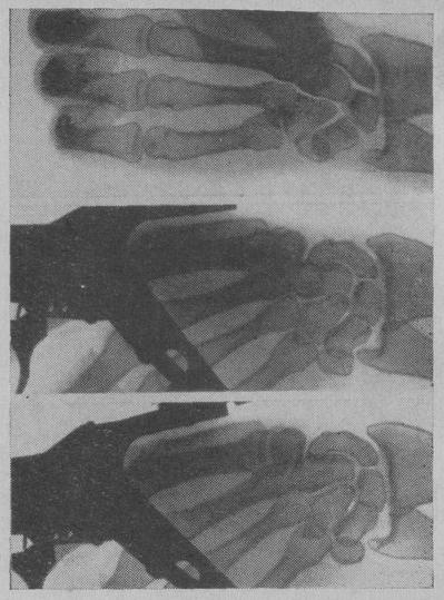Рентгенограмма суставов кисти при изготовке к стрельбе из пистолета