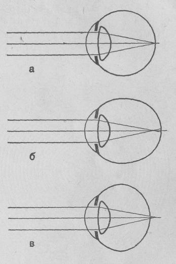 Схема преломления лучей в нормальном, близоруком и дальнозорком глазе