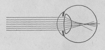 Схема преломления лучей в астигматическом глазе